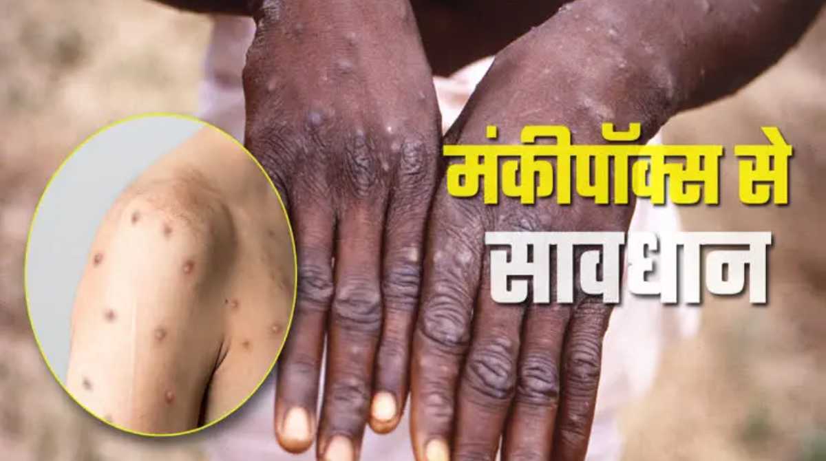 उत्तराखंड में डेंगू और मंकीपॉक्स को लेकर प्रशासन अलर्ट, पढ़ें गाइडलाइन…